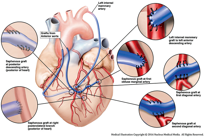 Coronary Artery Bypass Grafting (CABG)